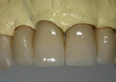 ZIRCONIA